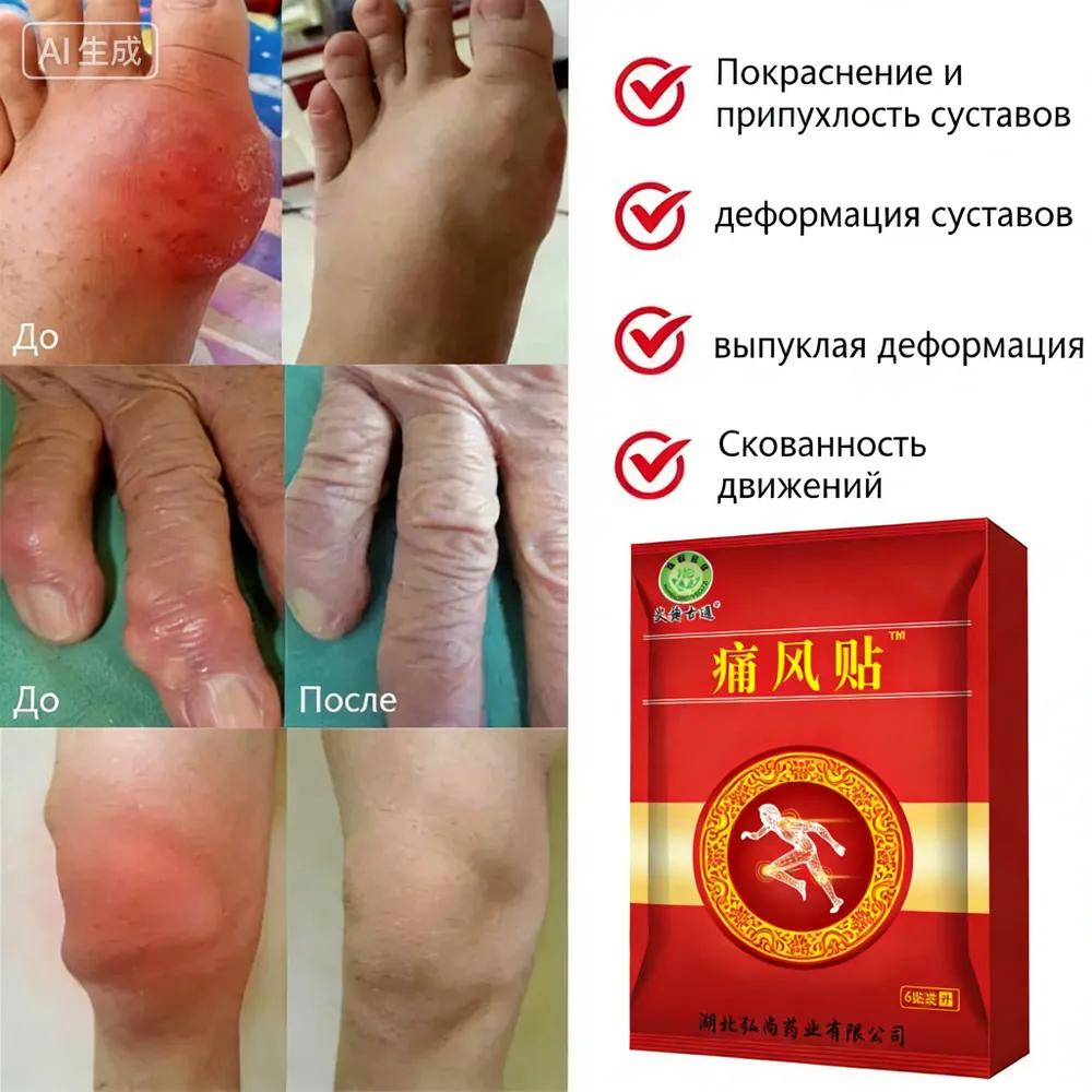 Professional gout patches for gout treatment hallux valgus arthritis relieve swelling and pain relief