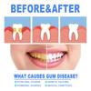 Damaged Gum Repair Care Gel Deep Cleaning Effectively Removes Yellow Teeth Stains Tartar Fresh Breath Teeth Cleaning Gel 4ml