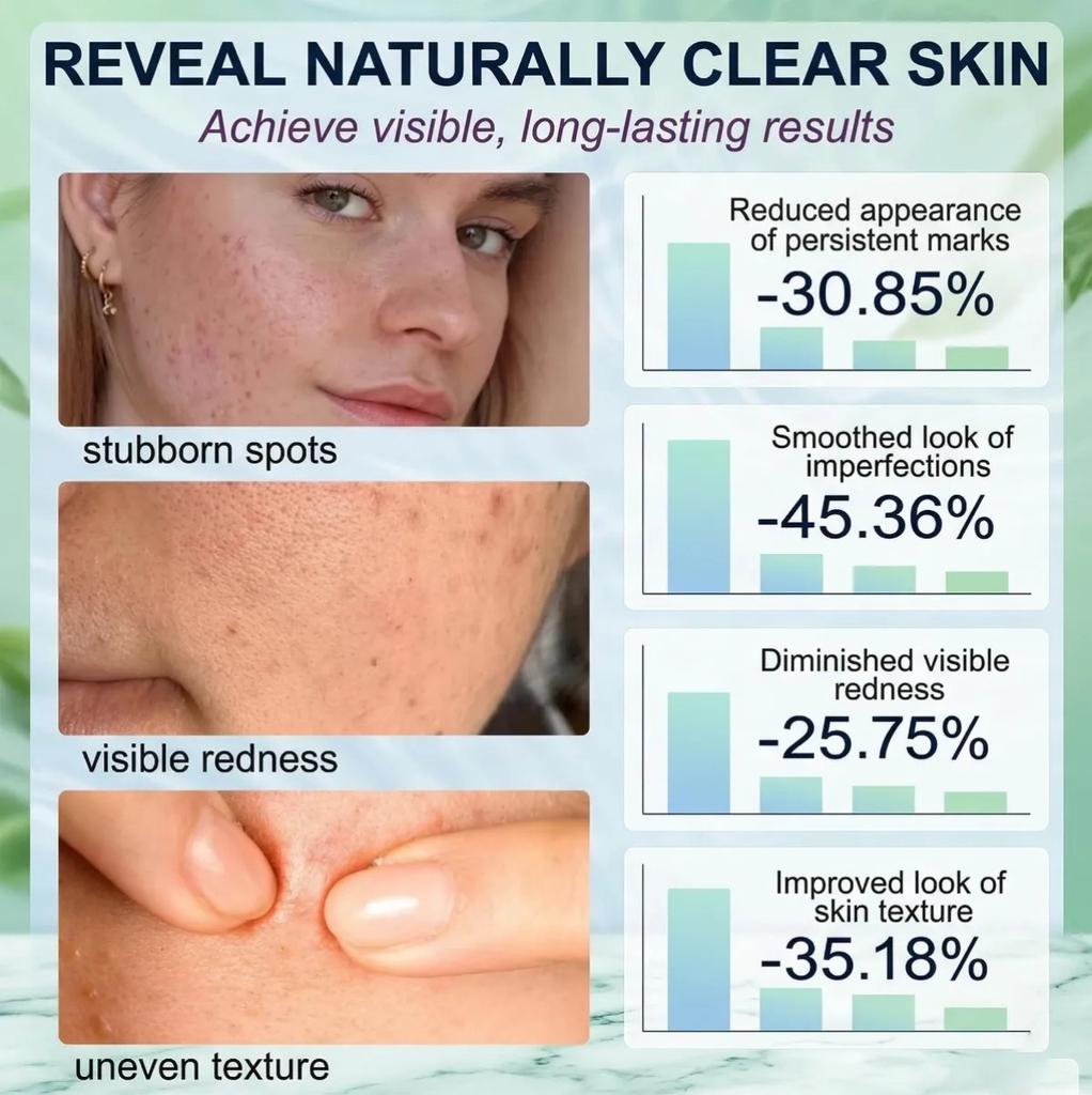Salicylsäure Porenverfeinernde Creme 30g, Gesichts Hautglättende Creme, Poren verfeinern, Sanfte Peeling-Creme für raue & zu Unreinheiten neigende Haut