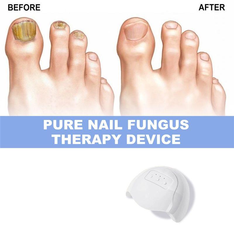 A04V Lasers For Nail Fungus Treatment Device Onychomycosis Cleaning Foot Repair Fungi Fungal For Nails Removal Anti Mushroom