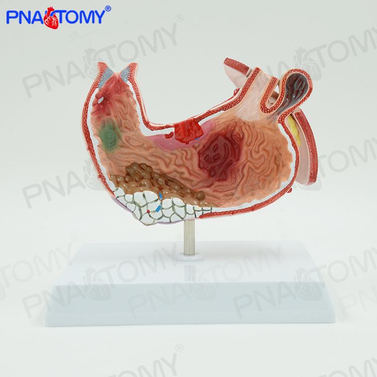Digestive System Anatomy Model: Human Stomach Structure with Pathology Display for Medical Education 14x32x17 cm