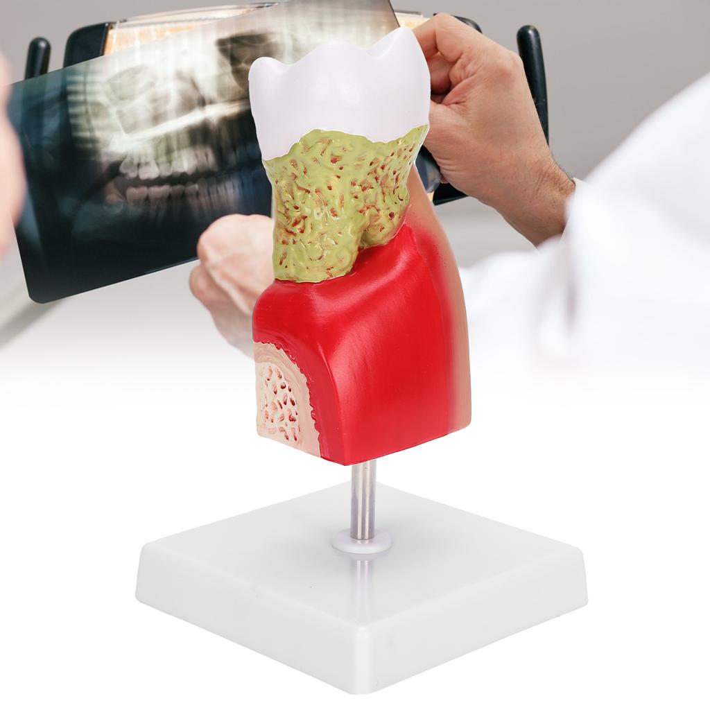 Dental Caries Tooth Model Dental Teeth Model for Teaching Training Patient Education