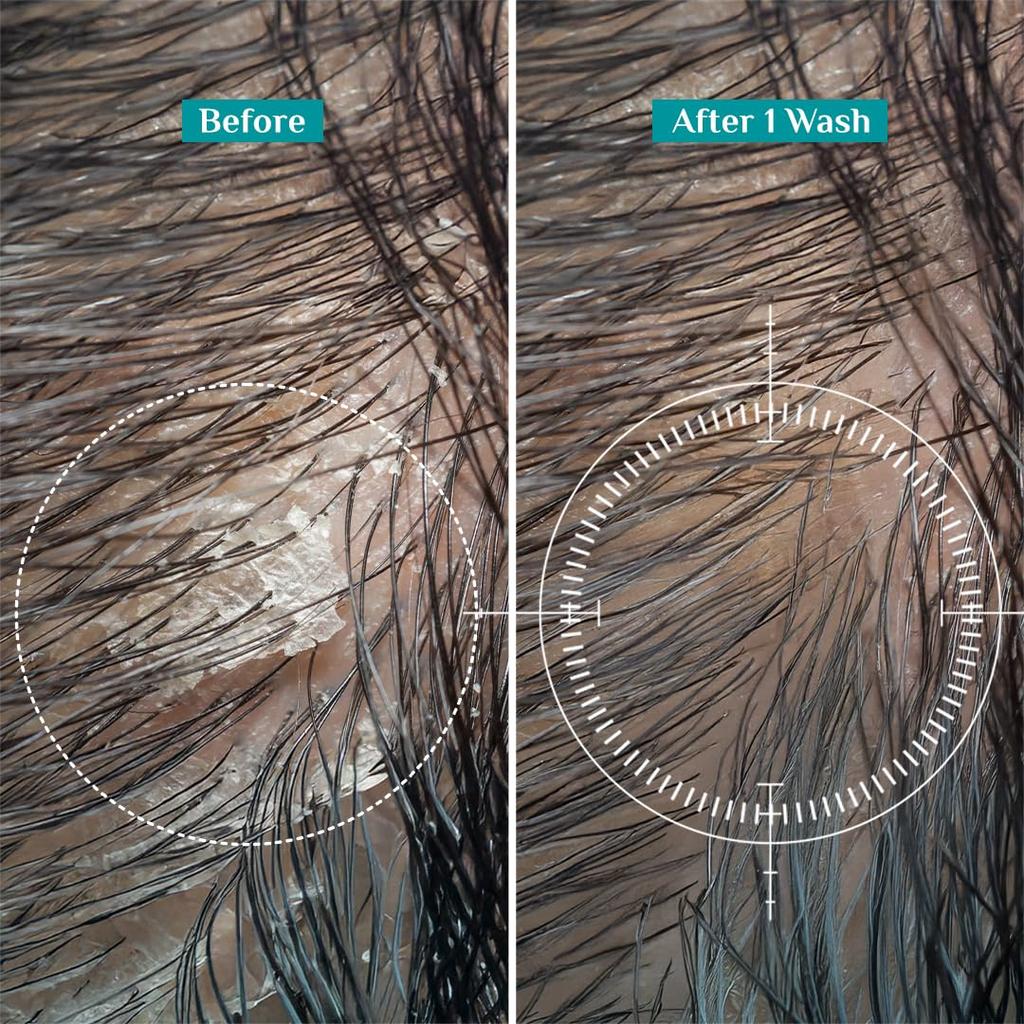 Pilgrim Australian Tea Tree Non-Drying Anti-Dandruff Shampoo 200 Ml X Pack of 2 for Smooth, Strong Hair