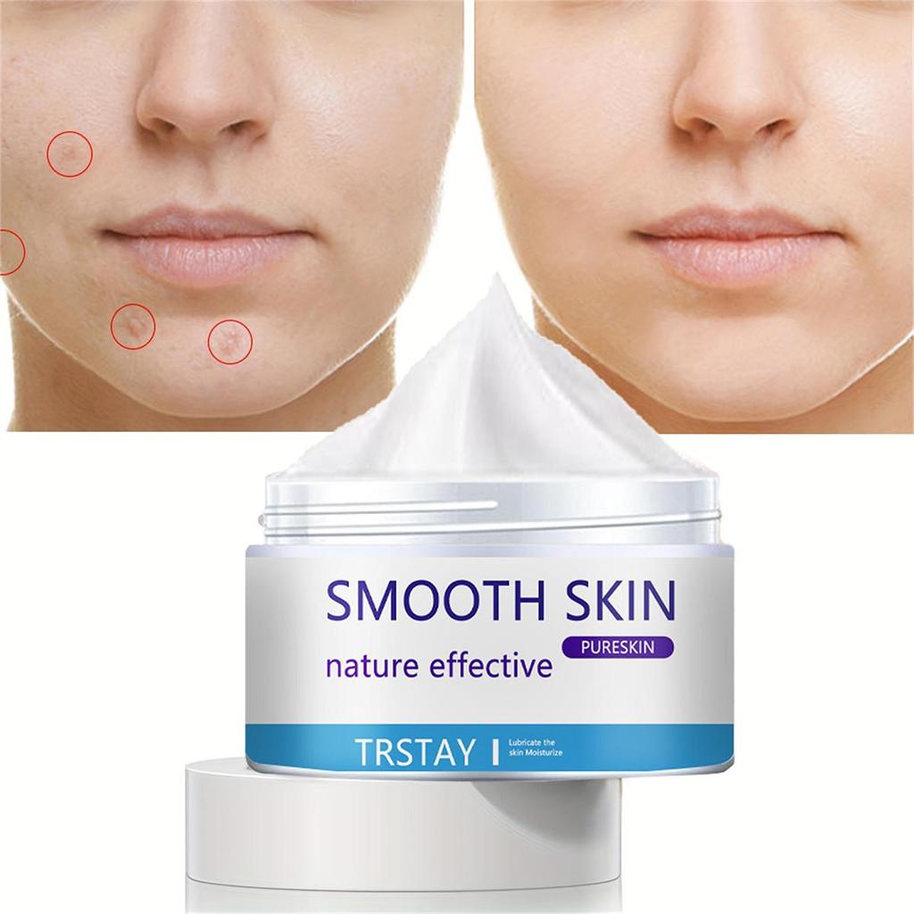Whitening and Acne Removing Essence Cream, Brightening Facial Skin, Anti-oxidation and Anti-aging, Moisturizing Cream