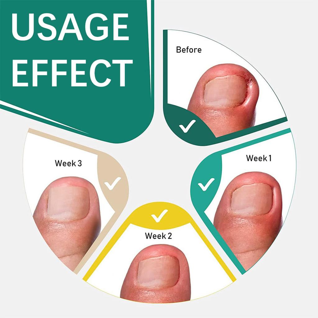 Aufkleber zur Korrektur eingewachsener Zehennägel für Hände und Füße, weicher Nagel, eingelegte Nagelverdickung, helle Nagelfurche, graues Nagelpflegepflaster, 50 Stück