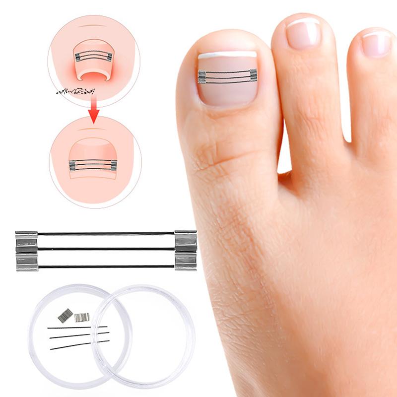 1 Set Professioneller eingewachsener Zehennagel Korrekturclip Spange Pediküre Erholungswerkzeug zur Zehennagelbehandlung Einwachsen Begradigungswerkzeug