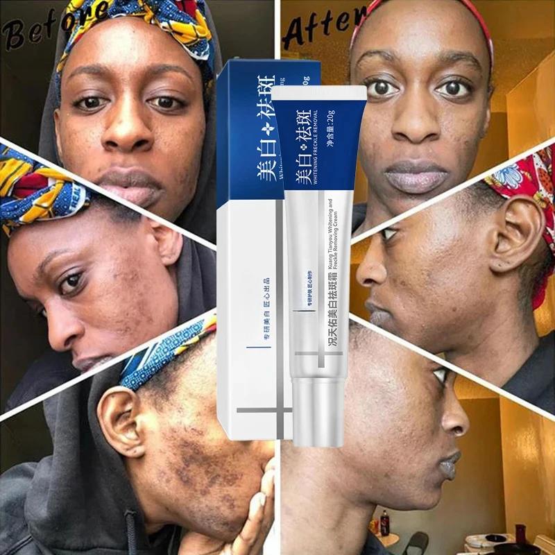 Crème blanchissante efficace pour les taches de rousseur, élimine le mélasma, atténue les taches brunes, hydrate, éclaircit la peau du visage, produit de soin