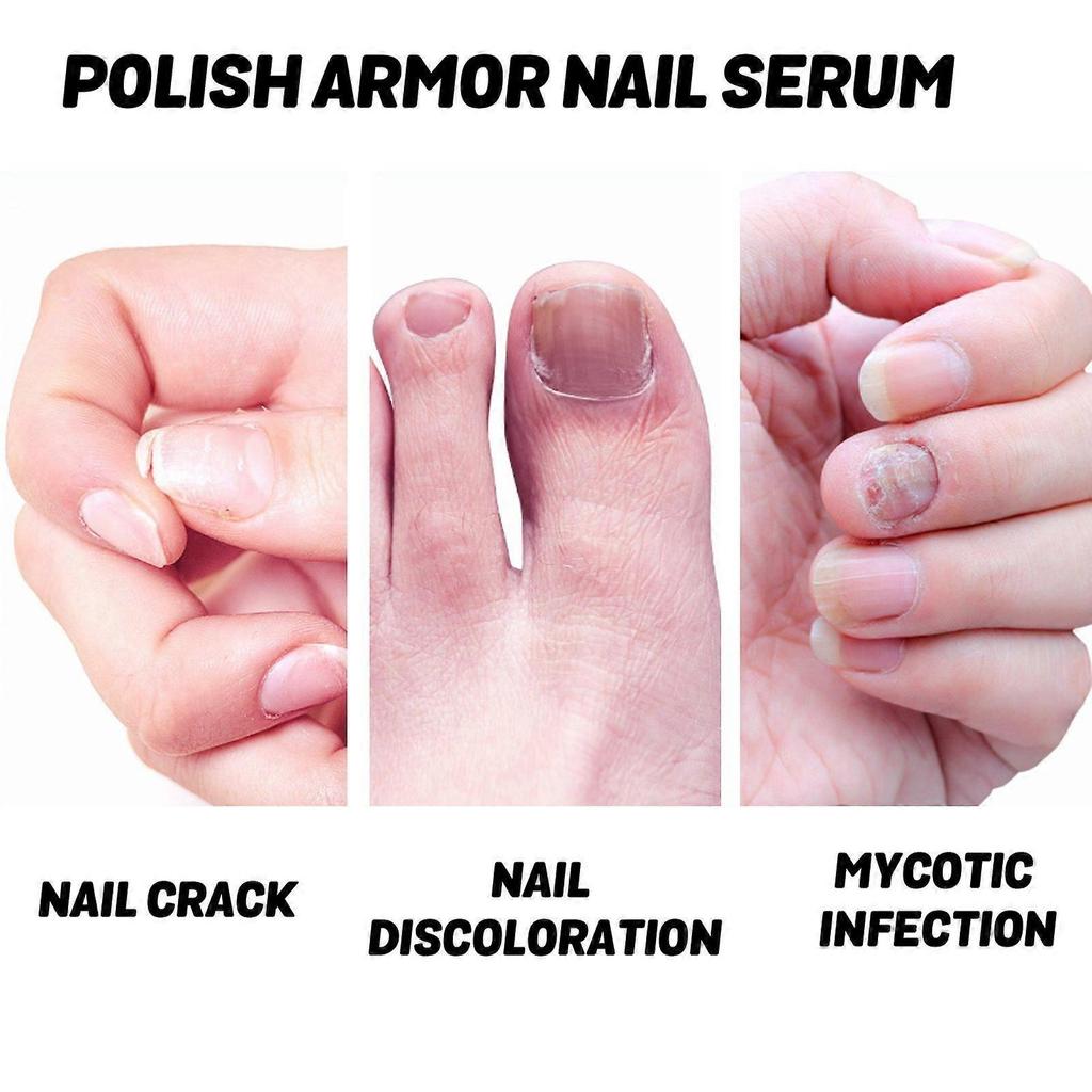 Ouhoe Nail Care Solution - Repairs Ingrown, Damaged, And Soft Nails, Nourishing And Brightening Nail Care Liquid For Hands And Feet