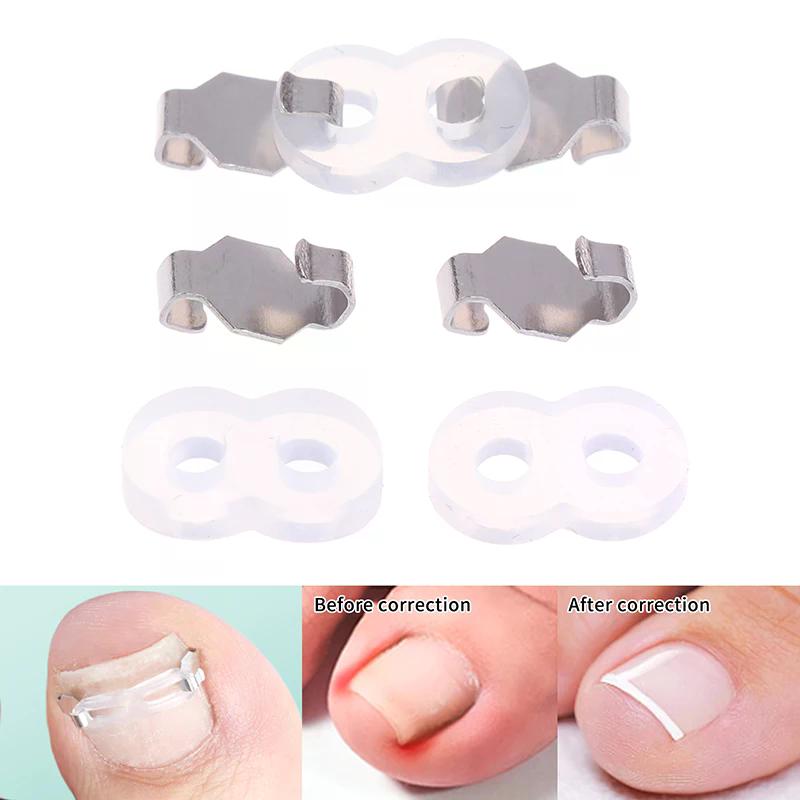 Set Tool 1/2 Ingrown Toenail Corrector Pedicure Recover Embed Treatment Professional Foot Care Correction