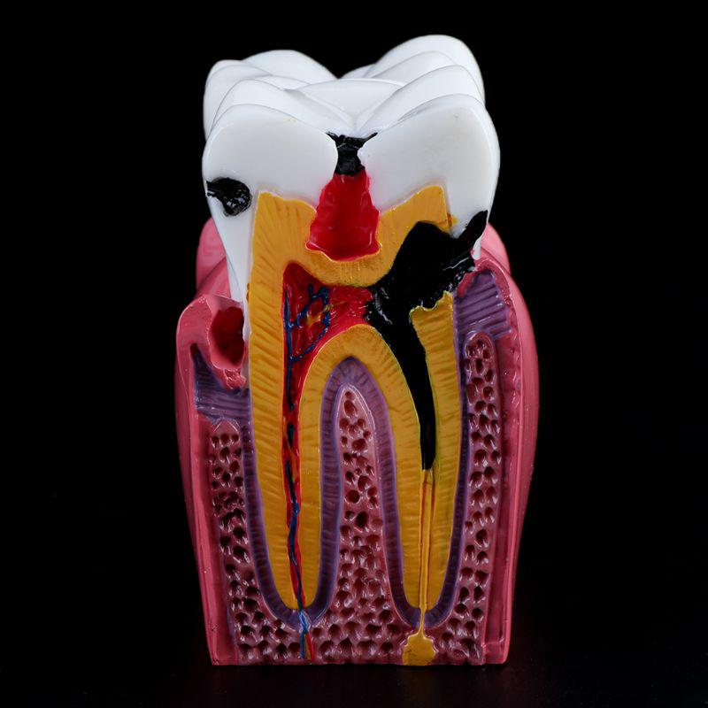 6násobný model zubů pro porovnání zubního kazu, anatomický, pro výuku v laboratoři zubní anatomie, studijní nástroj