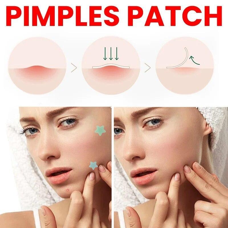 Acne Patch Lighten Acne Spots Repair Skin Blemishes Acne Patch