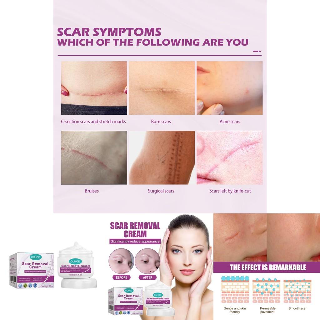 Ouhoe Scar Care Cream For Smoothing And Moisturizing Skin With Gentle Formula