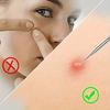 Acne Needle Set Blackhead Removal Tool Acne Extractor Acne Removal Set, Acne Nose Face Tool with Box for Blemishes