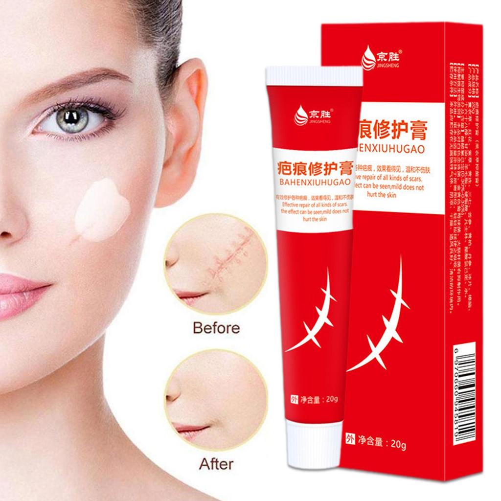 20 г крем для удаления шрамов от акне, хирургическое удаление растяжек, гель для кожи лица, отбеливающий пигментацию тела, Sm U4P9