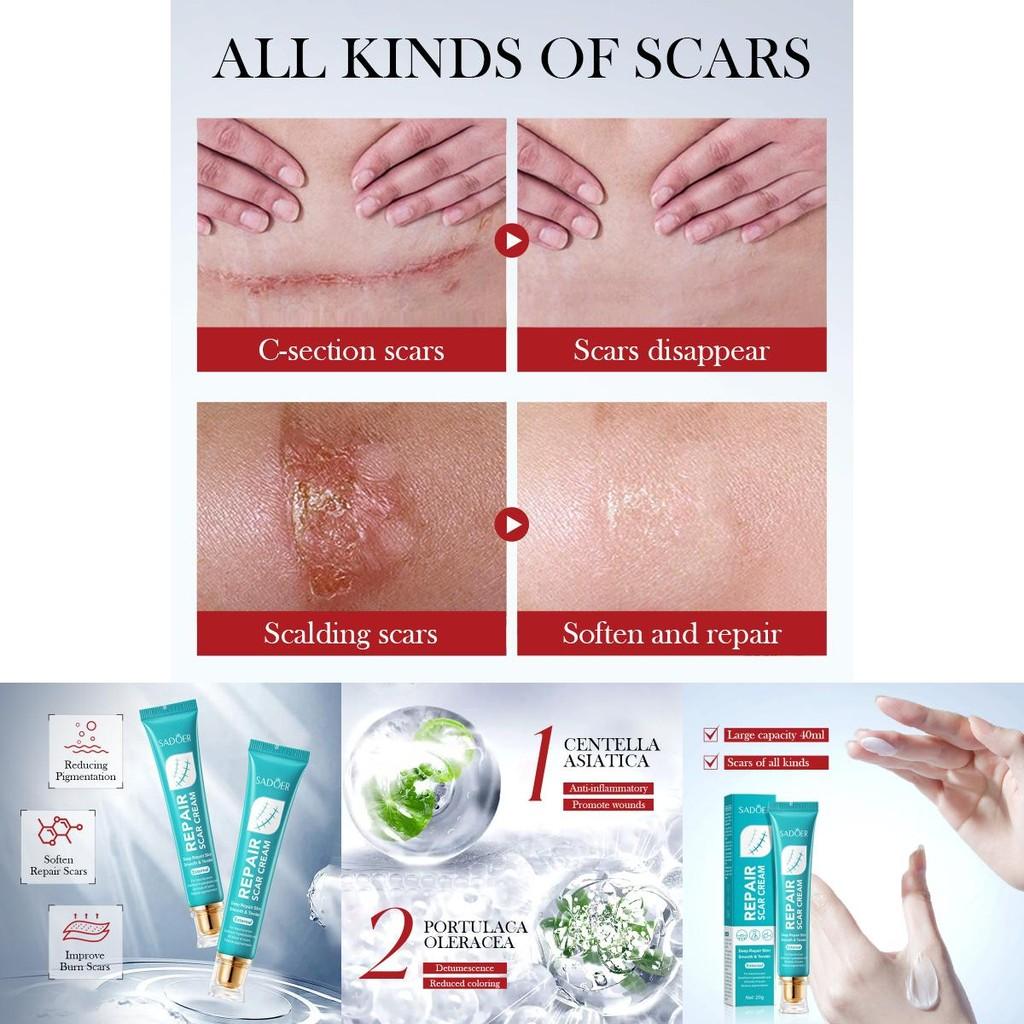 Sadoer Scar Cream Moisturizing Formula For Burns And Scars Suitable For All Skin Types