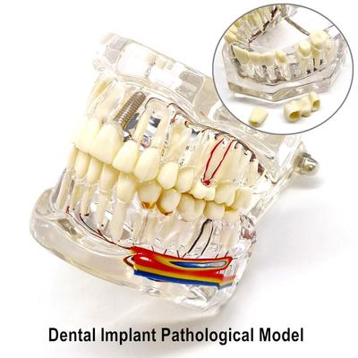 1 Piece Dental Implant Teeth Model with Nerve Dental Implant Pathological Model Dentist Students Communication Learning Research Oral Disease Teaching