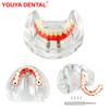 Model Nou de Implant Dentar 4 Implante Maxilar Inferior Punte Maryland Modele de Dinti Proteză Completă Typodont Pentru Educație Predare