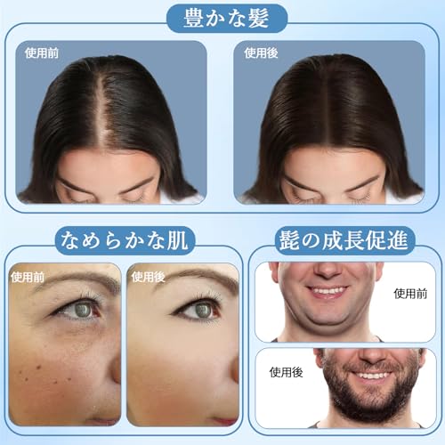 SrDiot Derma Stamp, 140 Needles, Adjustable from 0-3.0mm, Derma Roller for Cosmetic Acupuncture and Microneedling, for Skin Rejuvenation, Scalp Remova