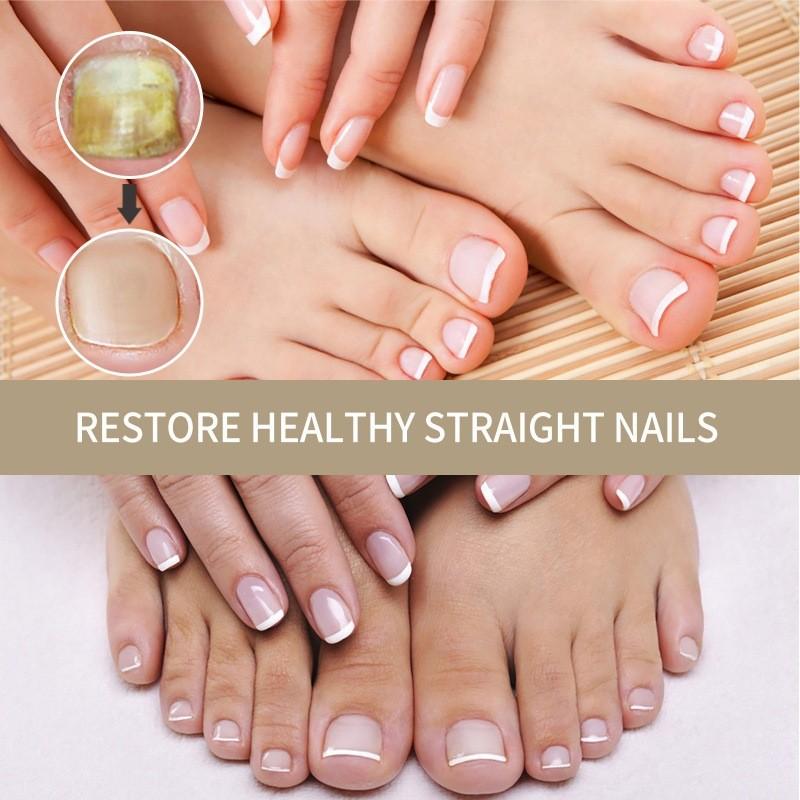 Essence de Réparation pour Ongles West Month Traitement Nourrissant pour Ongles et Orteils Endommagés 20ml