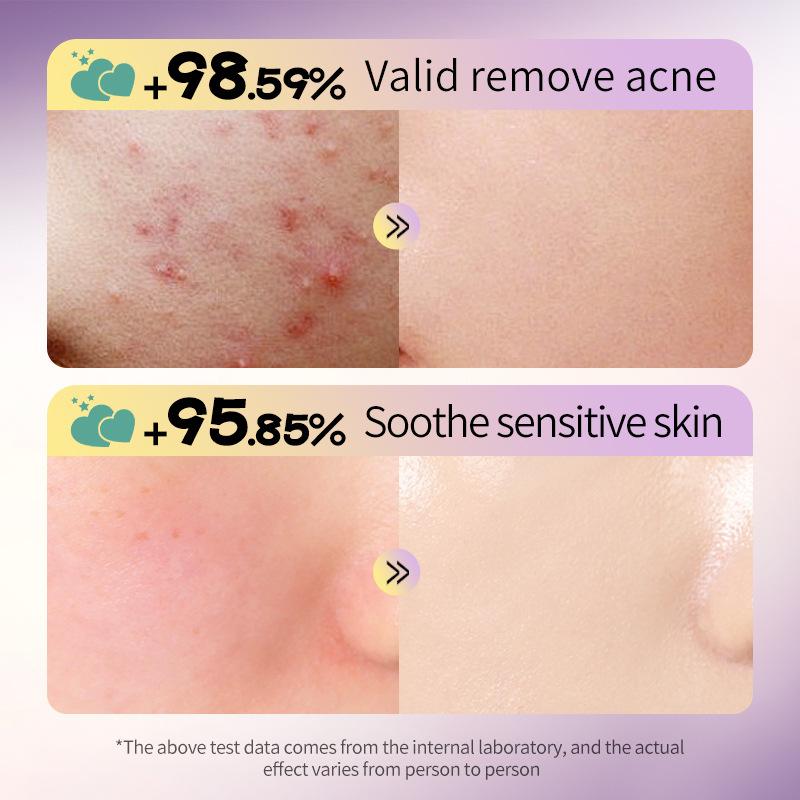 Sternförmiger Hydrokolloid-Akne-Patch, entzündungshemmend und antibakteriell.