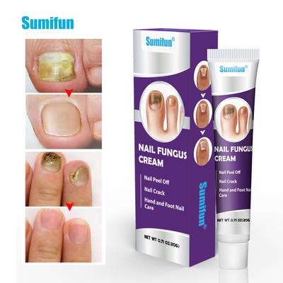 Onychomykose-Reparaturcreme - 20 g Nagelreparaturcreme zur Entfernung von Nagel-Onychomykose, Pflege und Befeuchtung der Nägel