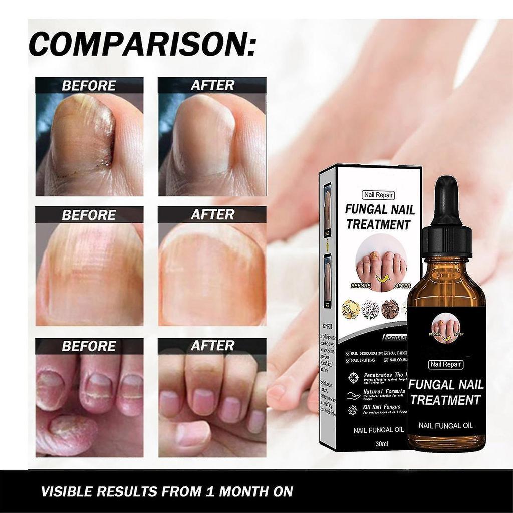 Gyors körömgomba kezelés, körömkarbantartó körömápoló folyékony kezelés, lábgombásodás 30ml