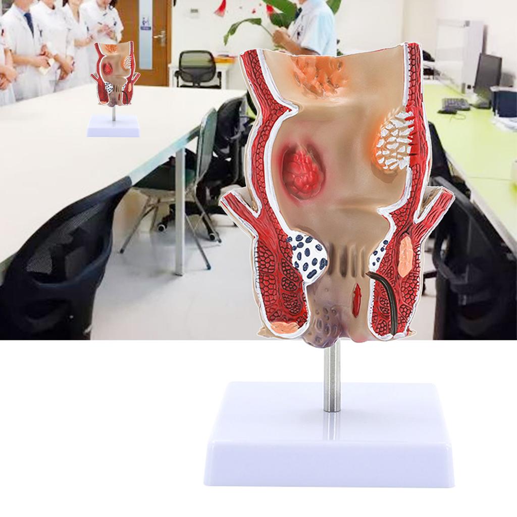 Human Pathologies of Rectum Model Medicals Teaching Tool Human Rectum Model Human Anatomy Model Teaching Supplies