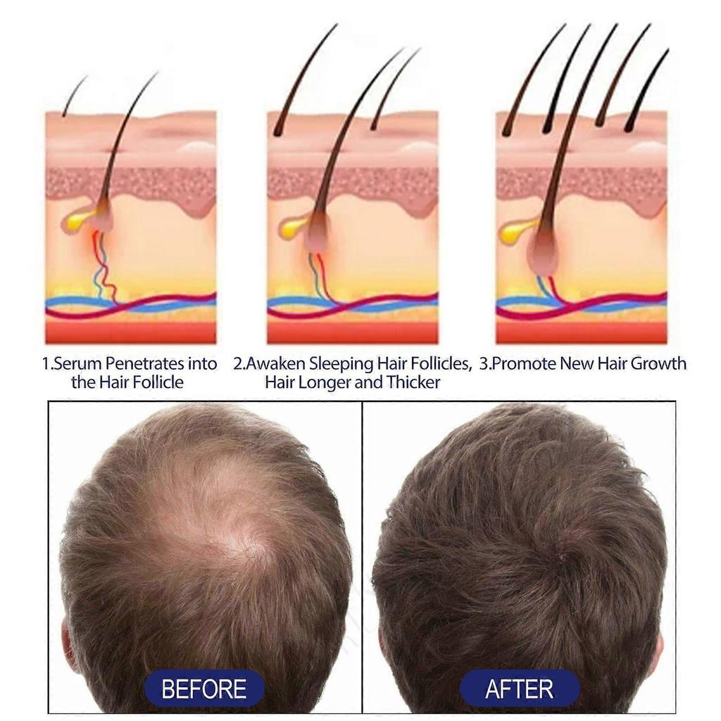 East Moon Men's Hair Thickening Foam - Repairs Hair Follicles, Makes Hair Thicker And Nourished