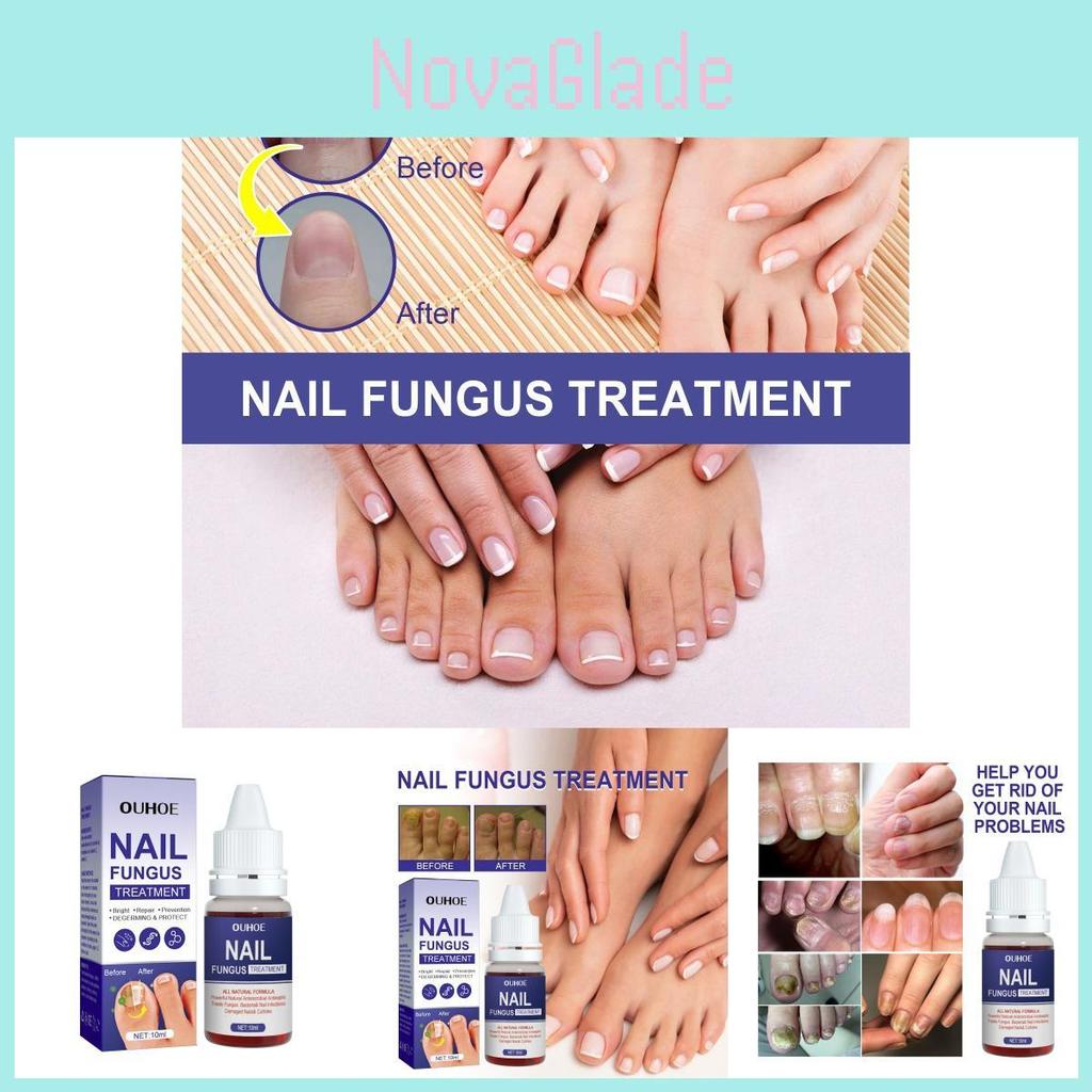 Ouhoe Nail Repair Solution Thickening Treatment For Ingrown Nails And Fungal Issues
