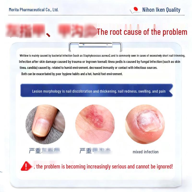 Que Yi Shi Jia Antifungal Nail Repair Solution