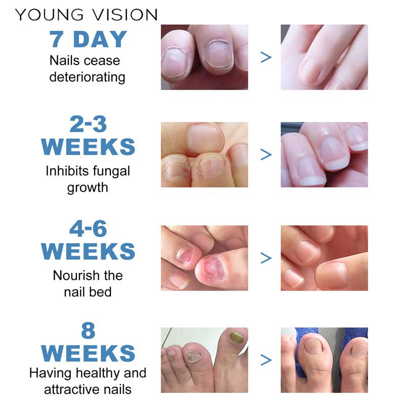 Plasture de îngrijire a unghiilor de la picior Plasture de reparare a unghiilor de la picioare