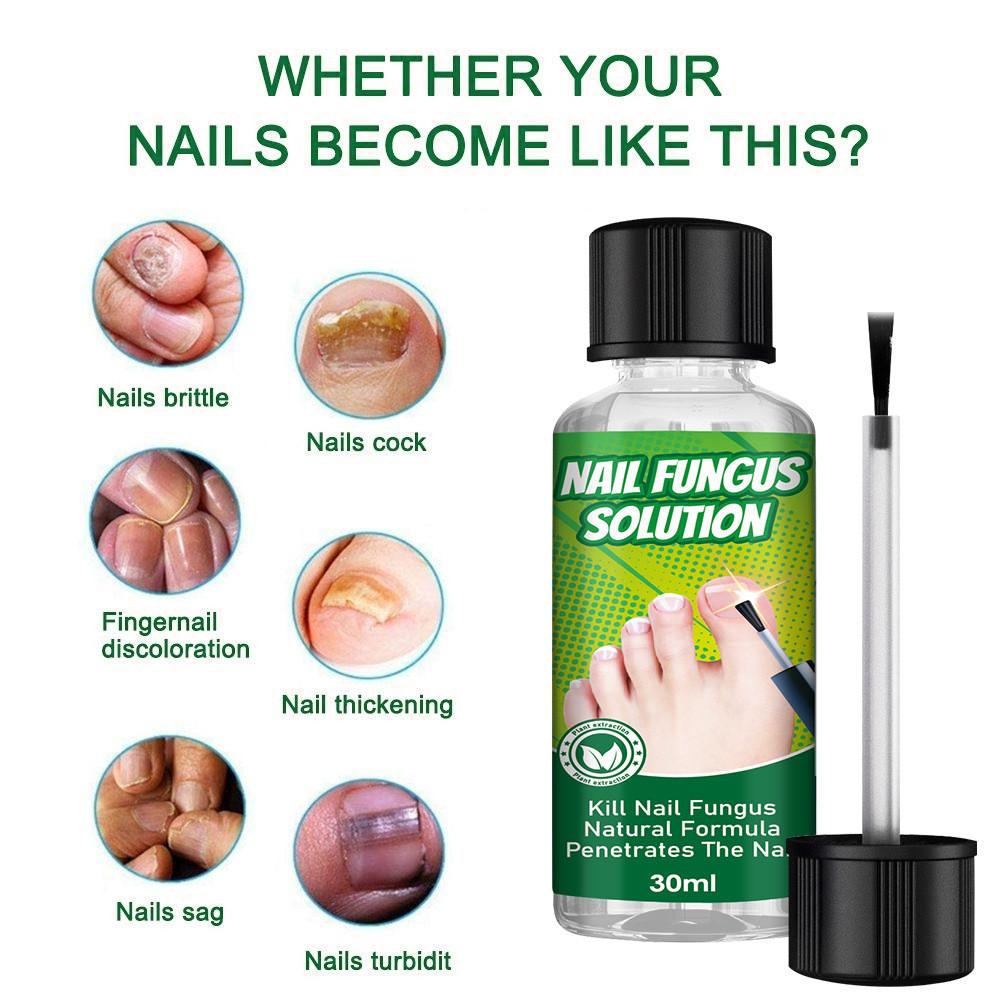 Hbesty Herbal Nail Fungus Treatment Liquid For Effective Foot Care And Healing