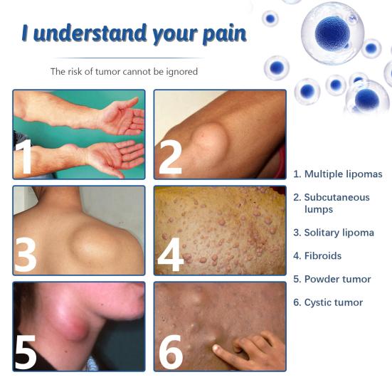 Yousheng 50ml Fatty Lump Spray Skin Care Safe Body Lipoma Removal Liquid Spray for Unisex