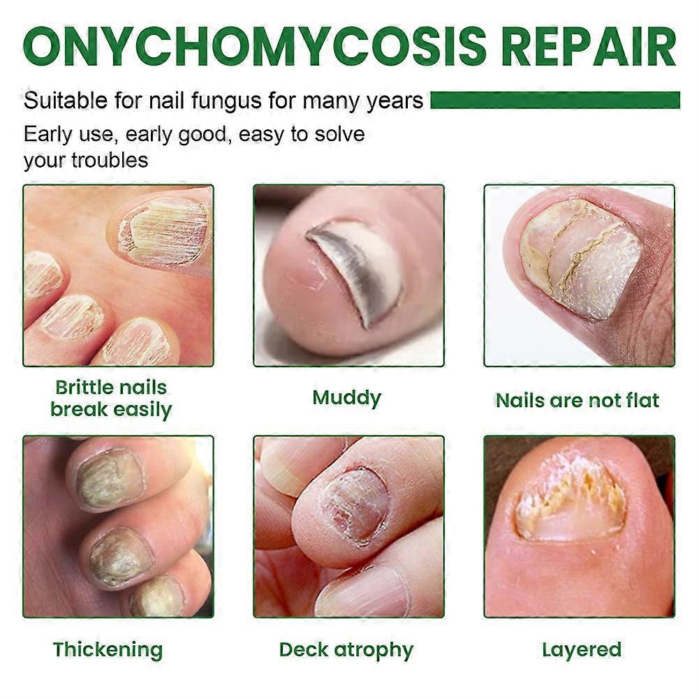 2X 2024 New Tea Tree Essential Oil Nail Fungus Repair Liquid, Treatment for Thickening, Discoloration, Softening, Onychomycosis Care, 20ml