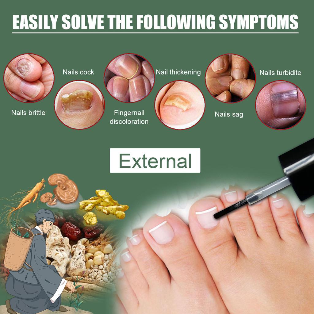 Eelhoe 15ml Toenail Treatment Liquid For Fungal Infections Strengthening Softening