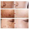 Ampoule éclaircissante Spot Ampoule d'essence blanchissante Élimine les taches de rousseur et les taches de vieillesse, améliore la pigmentation du visage, 30 ml, 1 pièce