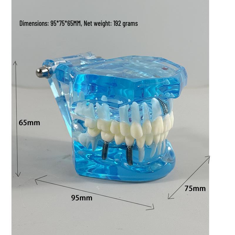 Прозора Знімна Повна Модель Щелепи з М'якими Яснами та Зубами для Підготовки до Імплантації