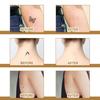 Skin Concealer Patch, Skin Scar Acne Mark Cover Patch Skin Color Patch Waterproof