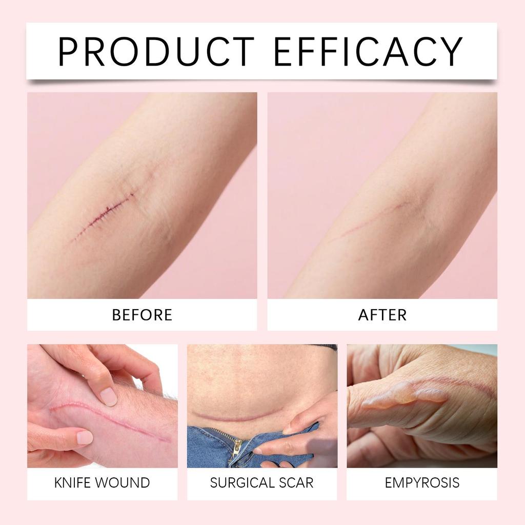 XIMONTH Scar Care Patches, Gentle Formula 24-Hour Breathable and Skin-Friendly Reduces Hypertrophic Scars