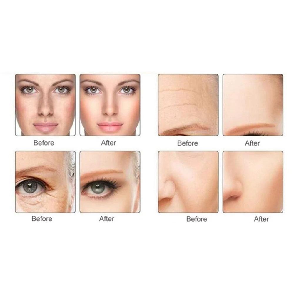 Diamant-Dermabrasion, Gesichtspflege, Schönheitsgerät, Entfernung von Narben, Akne, Porenpeeling, Massagegerät, Mikrodermabrasion, Heimgebrauch