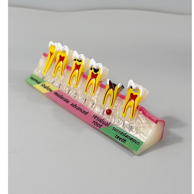 Прозора Знімна Повна Модель Щелепи з М'якими Яснами та Зубами для Підготовки до Імплантації