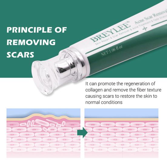 Breylee Acne Scar Removal Cream Stretch Marks Treatment Repairing Skin Care