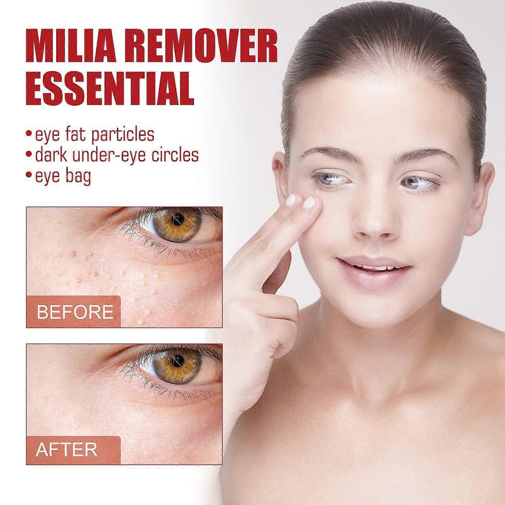 Speedy Milia Remover Treatment Cream, Helps Dissolve and Reduce Milia, Whiteheads, Blackheads, 30ml