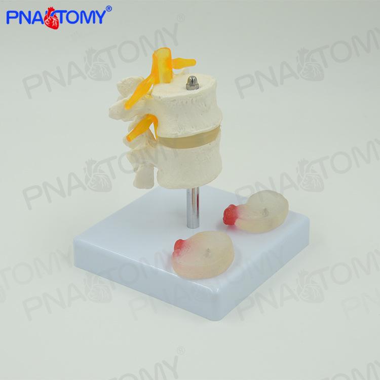 Lumbar Disc Herniation Model: Dual Lumbar Vertebrae for Orthopedic Massage Teaching 11 x 11 x 12