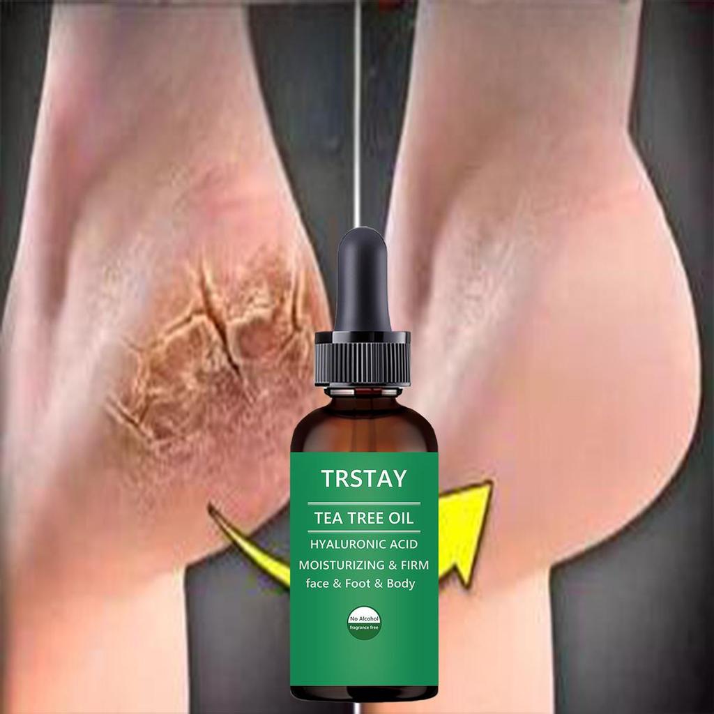 Fotbehandling:  Botanisk fotkrem Fuktighetsgivende fotpleieessens for tørr hud, sprukne hæler, sterk helbredende kraft, soppdrepende