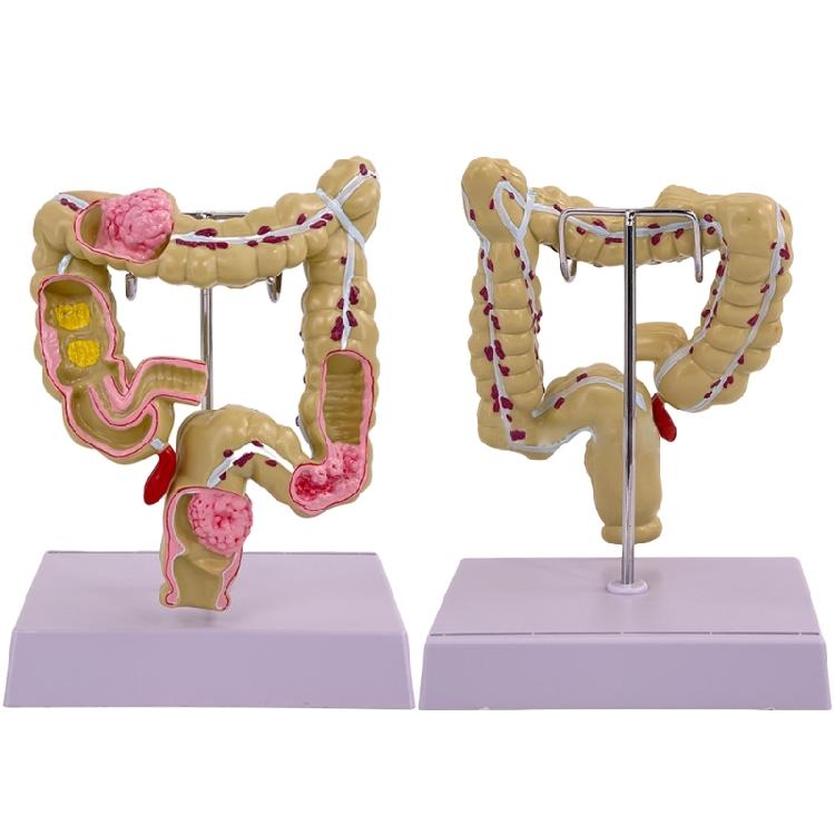 Pathologien des Dickdarms beim Menschen Modell Medizinisches Lehrmittel Modell des menschlichen Dickdarms Modell der menschlichen Anatomie