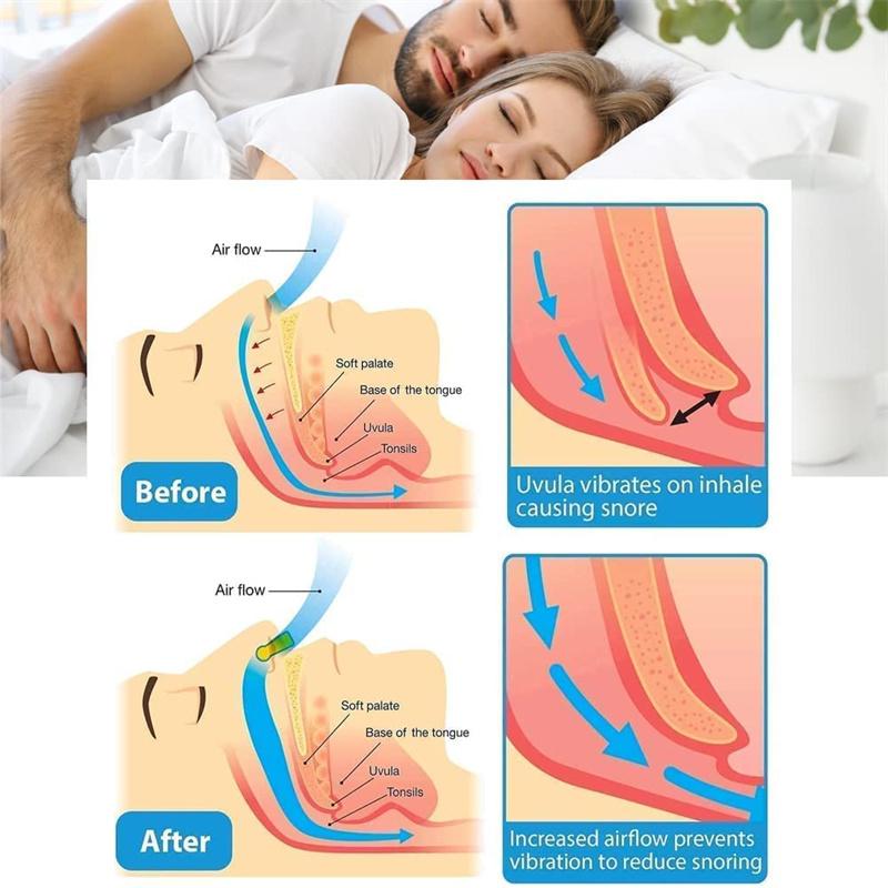 Anti-snoring anti-snoring artifact for men and women to prevent snoring snoring sleep anti-snoring device respiratory aligner
