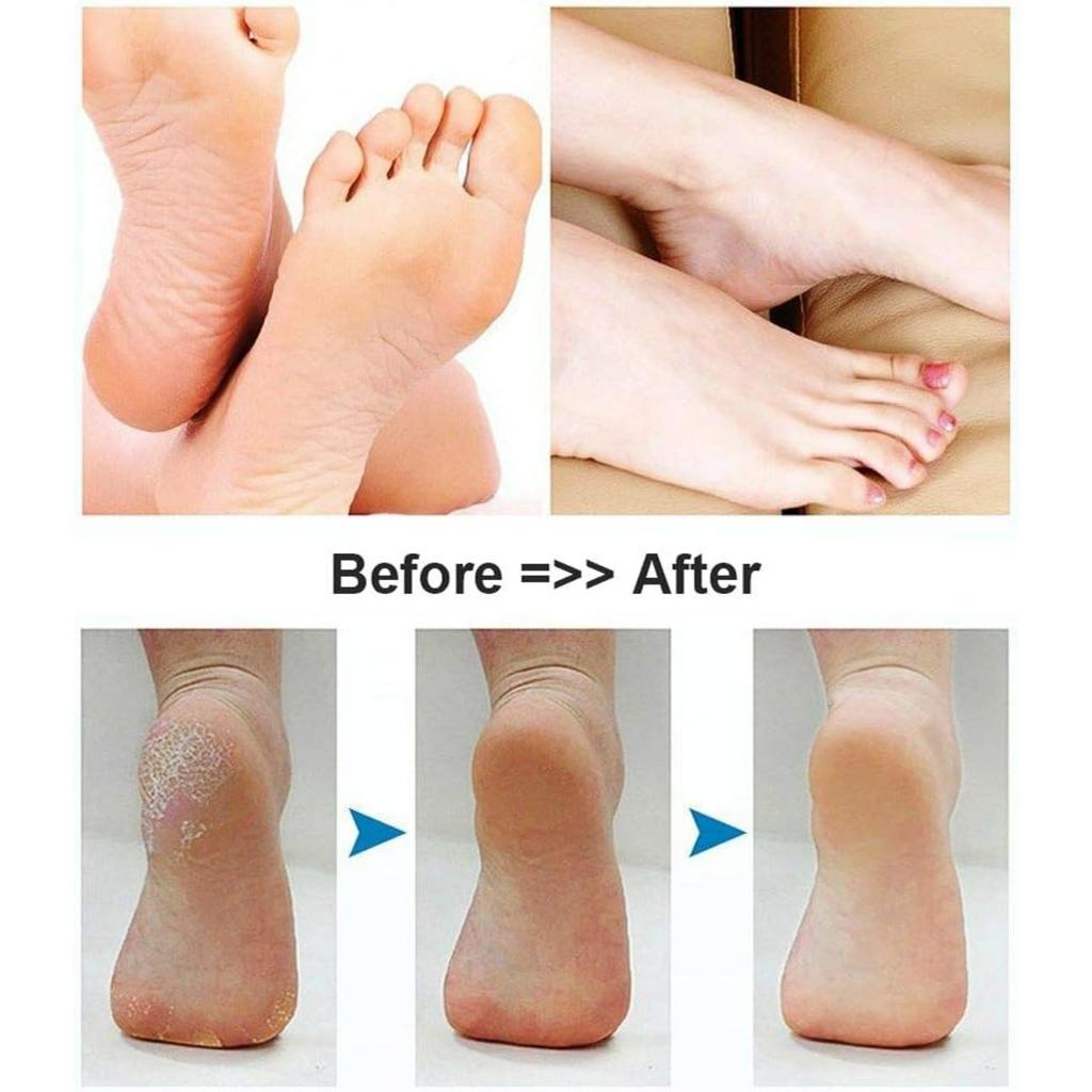Foot Scrubber Electric Callus Remover Rechargeable Foot File Hard Skin Remover Pedicure Tools Electronic Callus kit for Cracked Heels and Dead Skin