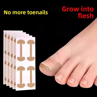 L'outil d'amélioration de l'ongle pour le sillon unguéal - Isole l'ongle d'orteil, permet la croissance de l'ongle et remplit la zone avec un tampon de rembourrage.