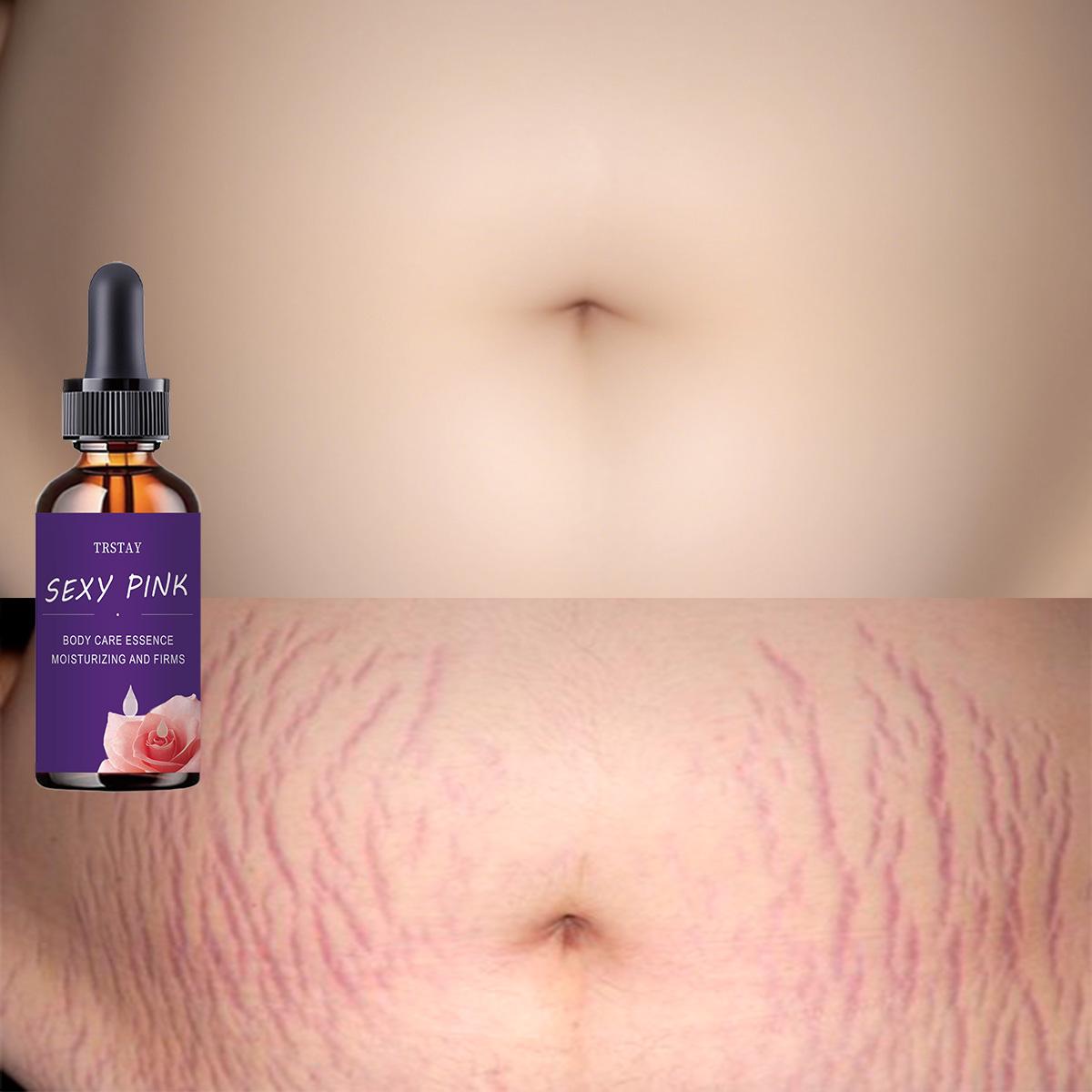 

TRSTAY крем от растяжек удаляет шрамы, отбеливающий крем, кремы для лица, уход за кожей 5ml